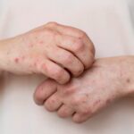 Informa Secretaría de Salud que suman cinco los casos de sarampión